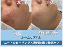 アロマ(AROMA)/凹凸跡/毛穴/越谷せんげん台