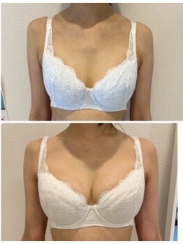 ルフルリール(Refleurir)/◆バストアップ症例/育乳◆