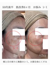 由縁/シミ改善プログラム