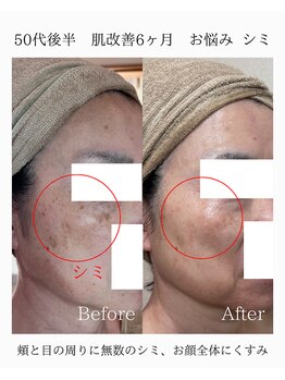 由縁/シミ改善プログラム