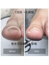 巻き爪改善