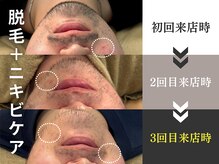 メンズオージー 岡山中区(men's O.G)の雰囲気（【ヒゲ脱毛】ワックス×光脱毛！毛量の減りが早い＆ニキビケア◎）