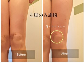 わたしのネイルとよもぎ蒸し/