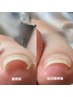 【フット巻き爪ケア】その場で痛み解消★2本巻き爪矯正+フットネイルケア