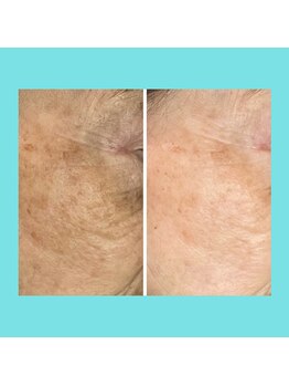 シエン ボーテ 馬車道 関内(Cyen BEAUTE)/3ヶ月の効果