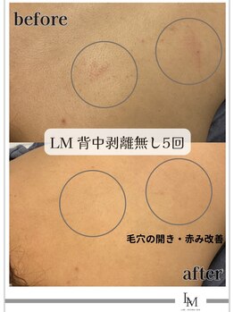 ライム 池袋東口(LIME)/Before&After　背中