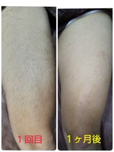 ヒーリングデトックス リラックリ(HealingDetox RELUCKRY)/ひざ上脱毛★経過途中写真