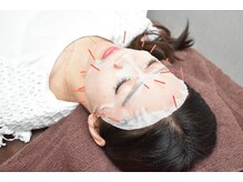 用賀駅前整骨院 鍼灸マッサージ院/【ご褒美施術】幹細胞美容鍼