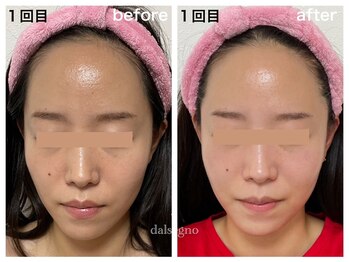 ダルセーニョ/１回での変化が凄すぎました！