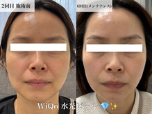 ウィ アネラ(U'i Anela)/WiQo水光ピール