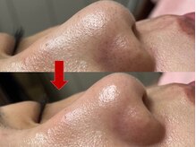 ブリリアン デイスパ 阪急西宮ガーデンズ店(BRILLIAN DAYSPA)/毛穴洗浄フェイシャル