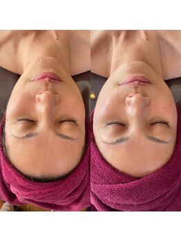 小顔フェイスラボ 鈴鹿店(小顔FaceLabo.)/◆たるみ改善◆