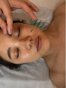 ハナコ 健軍店(HANAKO)の写真/美容鍼では極細の鍼を使用！変化を実感できる美容鍼で肌のハリ・ツヤ・シミたるみにアプローチ◎