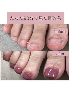 ティアラネイル 宇都宮/深爪矯正