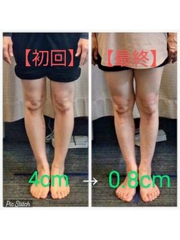 クシロ鍼灸整骨院/【O脚矯正】施術例