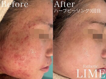 ライム 松本(LIME)/ハーブピーリング|ニキビケア