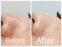 サロン ド ヒノキ(Salon de HINOKI)/肌質改善ハーブピーリング