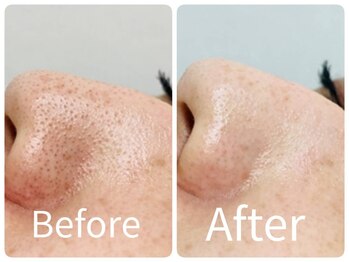 サロン ド ヒノキ(Salon de HINOKI)/肌質改善ハーブピーリング