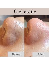 シエルエトワレ/毛穴エクストラクション