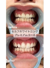 シューティングハーツ(SHOOTING HEARTS)/白い歯で清潔感UP ☆