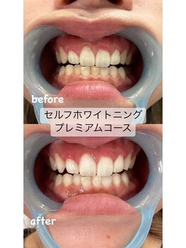 シューティングハーツ(SHOOTING HEARTS)/白い歯で清潔感UP ☆