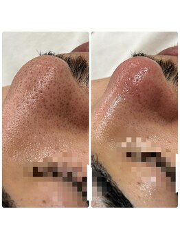 ジョアアンジェ 京橋店(joie ange)/ビオフィートの毛穴ケア