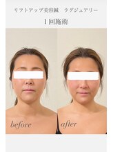 めい鍼灸院/美容鍼×LED光　ハリツヤVライン