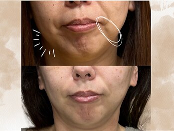 ハス(hasu.)/40代　月一回のたるみ改善コース