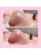 ホワイトラボ 新潟万代(White labo)/毛穴のお掃除！大人気毛穴洗浄☆