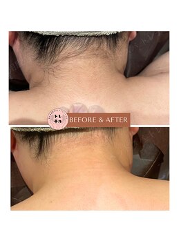 トレテル/女性全身脱毛うなじ