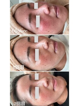 美バストアルファ(美bust α)/【シミケア】症例