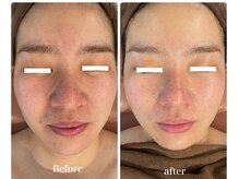 オレアグリーン 岡崎(OLEA green)/小顔矯正ビフォーアフター