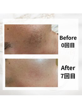 サロン ルイ(salonRui)/ひげ脱毛　before　afuta