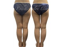 リアン 南熊本店(Lien)の雰囲気（1回でこの変化！［毛穴/小顔/痩身/ダイエット］レモンボトル超え）