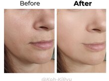 香嬉琉/Before&After［コースのお客様］