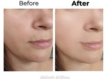 香嬉琉/Before&After［コースのお客様］