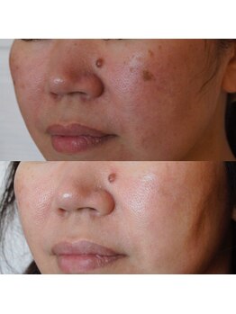 トラット エステアンドアイズ(tratto)/40代　お客様症例写真