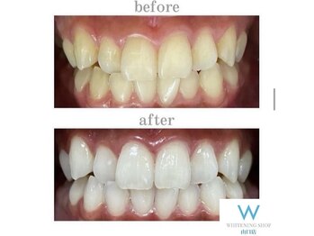 ホワイトニングショップ 山口店/山口ホワイトニング