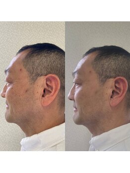 ヨサパーク カズリー(YOSA PARK kazury)/ハイディーナ30分の変化!