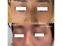リベルキョウト 京都駅前店(Liber Kyoto)/魔法のシミケア