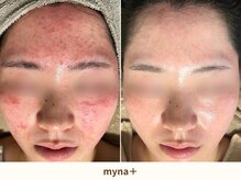マイナプラ 表参道(myna+)/肌質に合わせてカスタマイズ