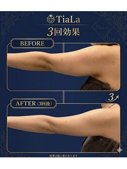 メンズアンドレディース エステティックサロン ティアラ(TiaLa)の写真/盛岡で二の腕ケアなら！ハミ肉を徹底ケアして華奢見え＆サイズダウンを叶える本格痩身エステ