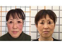 アイユーサロン(愛YOUsalon)/小顔矯正