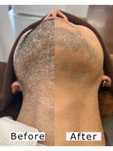 シャイニー/ヒゲ脱毛10回/２週間に1回