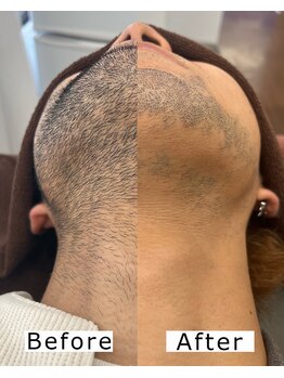 シャイニー/ヒゲ脱毛10回/2週間に1回