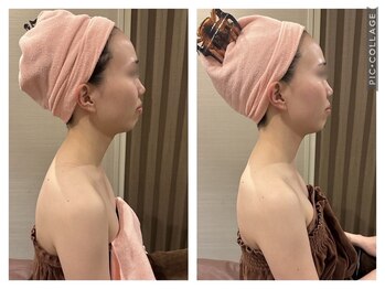 レイビス 仙台店(RAYVIS)/毛穴洗浄+美白+小顔2