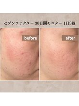 シーフェイス 横浜店(SEE FACE)/30日間美肌モニター ニキビ肌