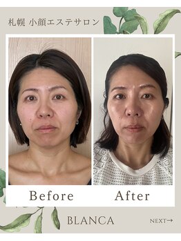 ブランカ(BLANCA)/小顔セラピアビフォーアフター