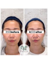 キュープ 相模原淵野辺店(Qpu)/たった4回で人生で1番小さな顔に