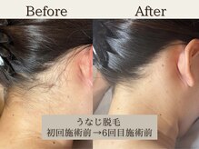 インベスト(INVEST)/うなじ脱毛